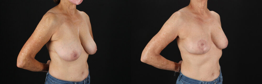 Breast Reduction case #8012