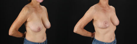 Breast Reduction case #8012