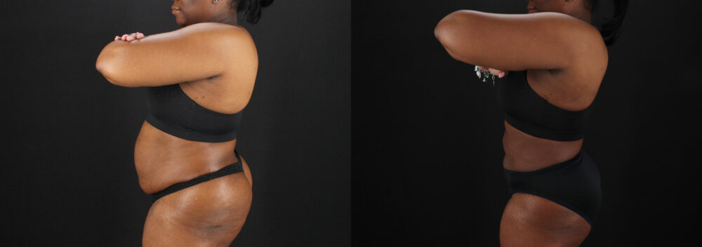 Liposuction case #6122