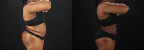 Liposuction case #6122