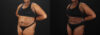Liposuction case #6122 slider thumbnail