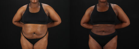 Liposuction case #6122