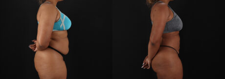 Brazilian Butt Lift case #5513