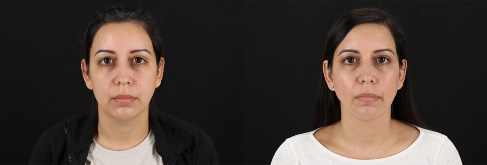 Submental Liposuction case #6956