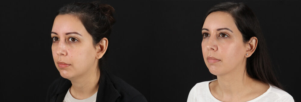 Submental Liposuction case #6956