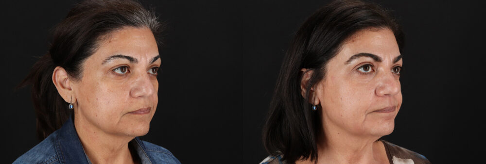 Cosmelan Chemical Peel case #5087