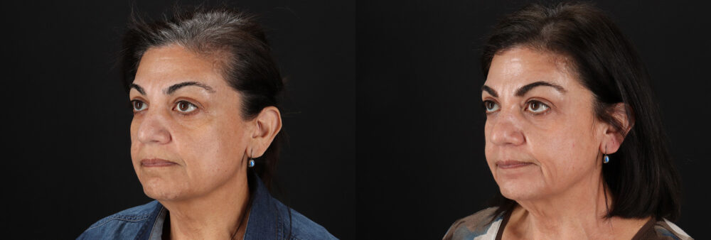 Cosmelan Chemical Peel case #5087