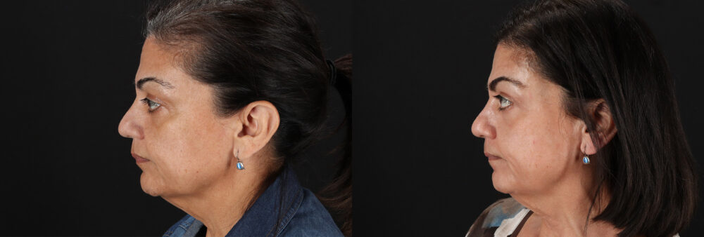 Cosmelan Chemical Peel case #5087