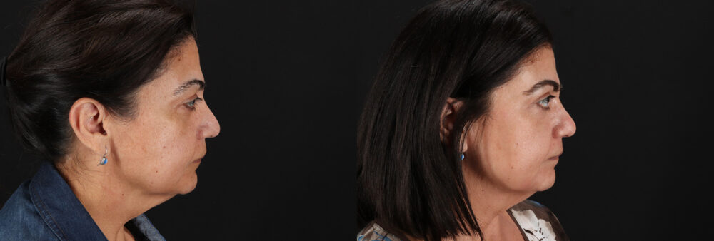 Cosmelan Chemical Peel case #5087