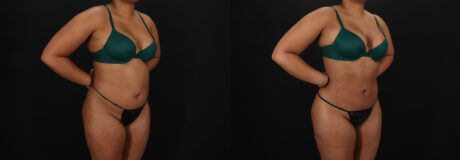 Brazilian Butt Lift case #5458