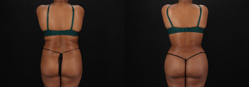 Brazilian Butt Lift case #5458