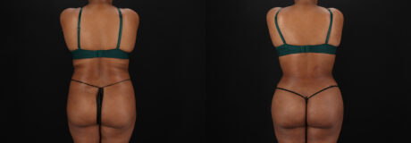 Brazilian Butt Lift case #5458