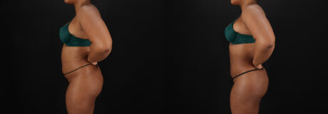 Brazilian Butt Lift case #5458