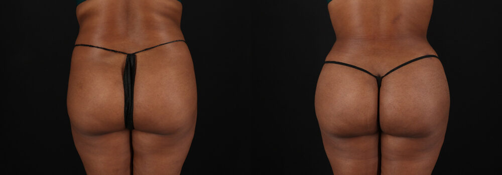 Brazilian Butt Lift case #5458