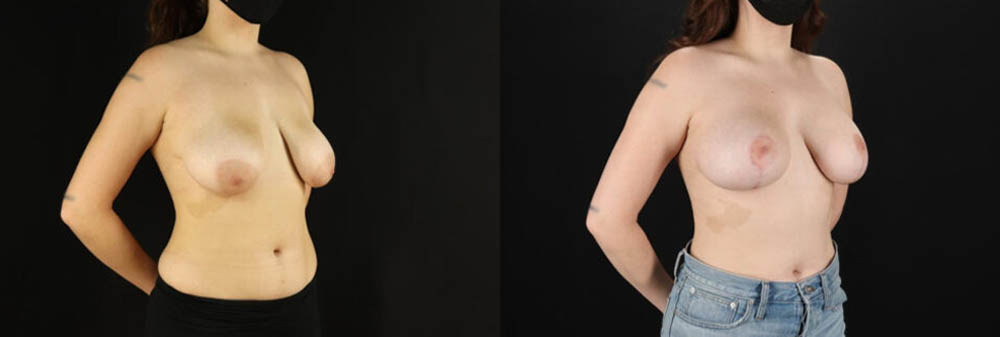 Breast Lift with Implants case #7884