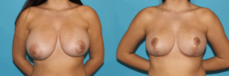 Breast Reduction case #7936
