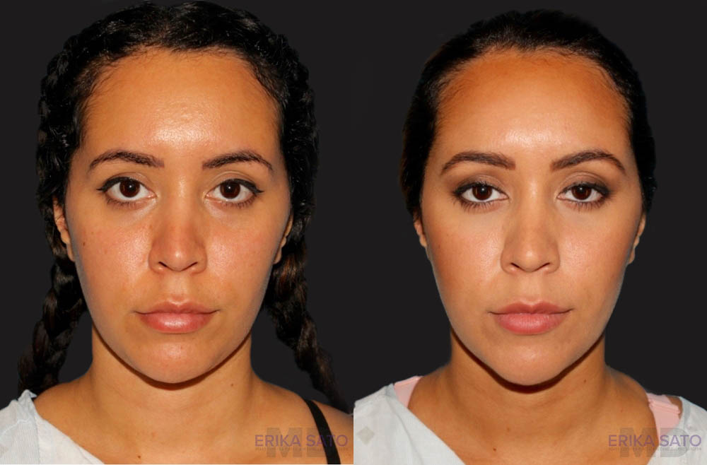 Submental Liposuction case #6943