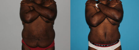 Post Bariatric Surgery (Massive Weight Loss) case #6774