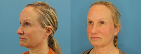 Profound RF Skin Tightening case #6906