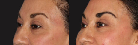 Blepharoplasty case #6888