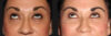 Blepharoplasty case #6888 slider thumbnail