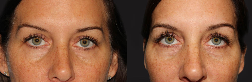 Blepharoplasty case #6890