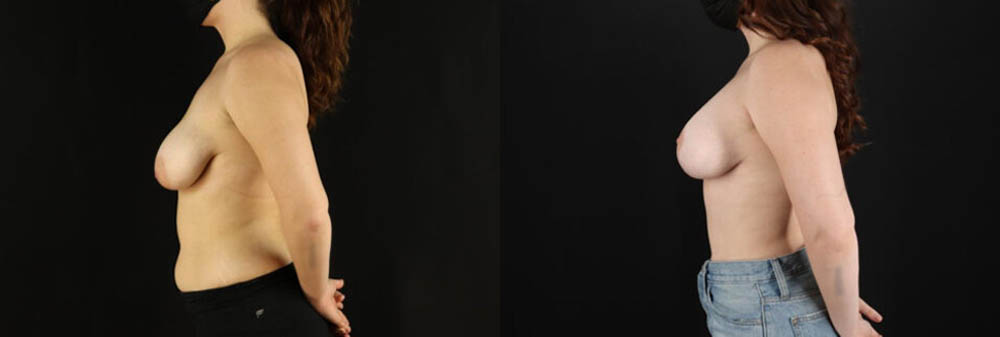 Breast Lift with Implants case #7884