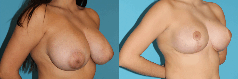 Breast Reduction case #7936