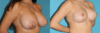 Breast Reduction case #7936 slider thumbnail