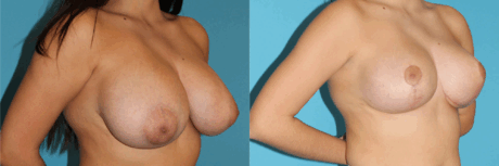 Breast Reduction case #7936