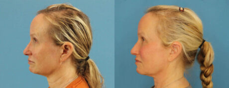 Profound RF Skin Tightening case #6906