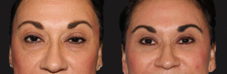 Blepharoplasty case #6888
