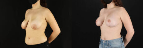 Breast Lift with Implants case #7884