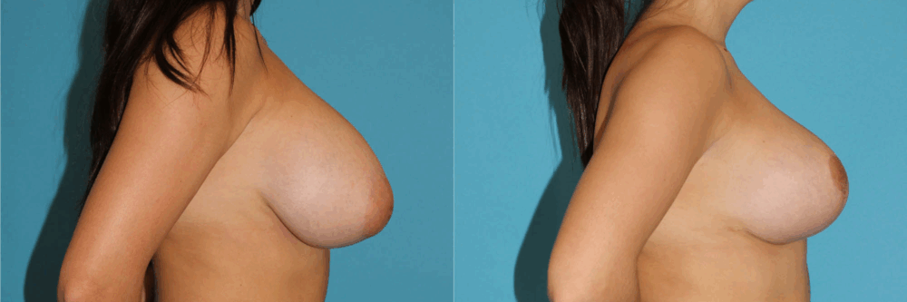 Breast Reduction case #7936