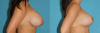 Breast Reduction case #7936 slider thumbnail