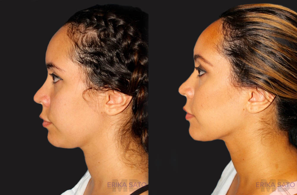 Submental Liposuction case #6943