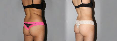 Liposuction case #5836
