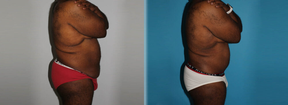 Post Bariatric Surgery (Massive Weight Loss) case #6774