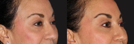 Blepharoplasty case #6888