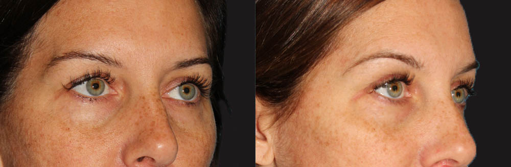 Blepharoplasty case #6890