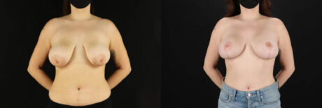 Breast Lift with Implants case #7884