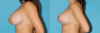 Breast Reduction case #7936 slider thumbnail
