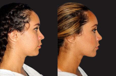 Submental Liposuction case #6943