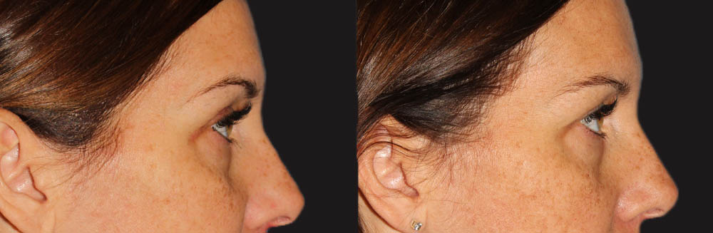 Blepharoplasty case #6890