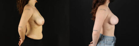 Breast Lift with Implants case #7884