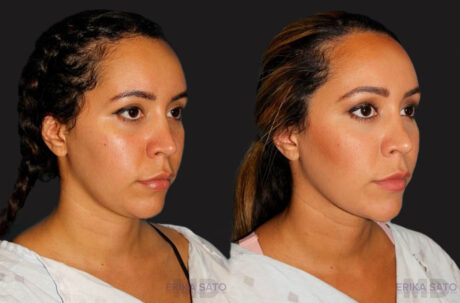 Submental Liposuction case #6943