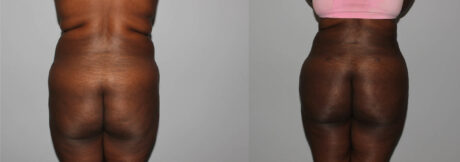 Liposuction case #5829