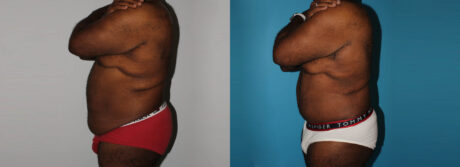 Post Bariatric Surgery (Massive Weight Loss) case #6774