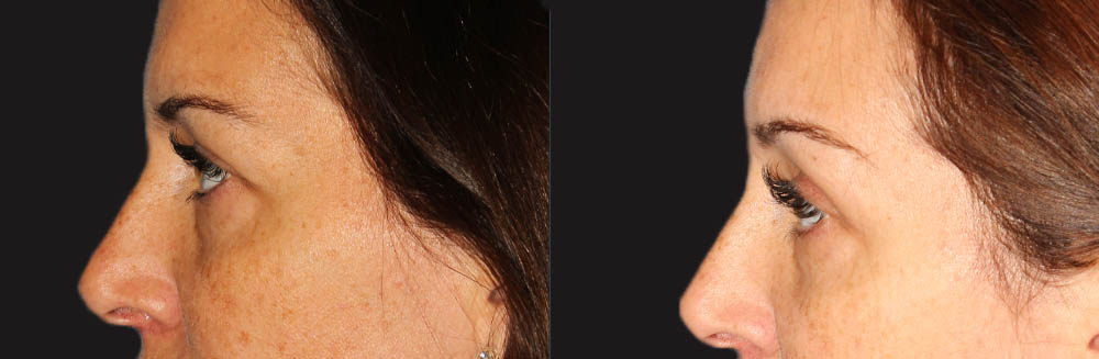 Blepharoplasty case #6890