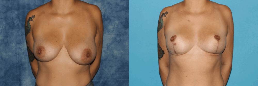 Breast Reduction case #7931